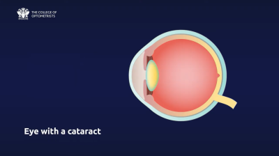 How might cataracts affect my vision? Thumbnail