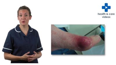 Looking after your diabetic foot ulcer (or foot attack) Thumbnail