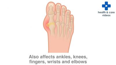 What is Gout and Pseudogout? Thumbnail