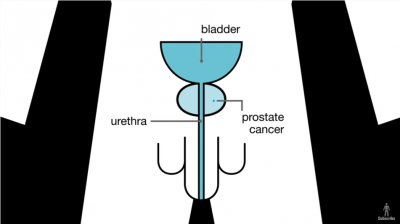 What is prostate cancer? Thumbnail