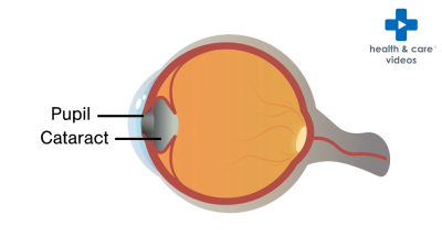 What is a cataract? Thumbnail