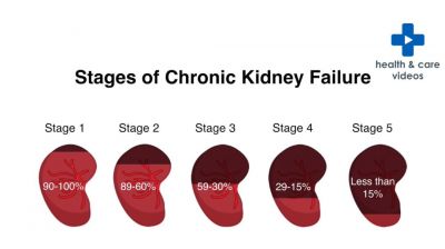 What is Chronic Kidney Disease (CKD)? Thumbnail