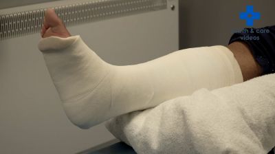Looking after your cast A guide for patients Thumbnail