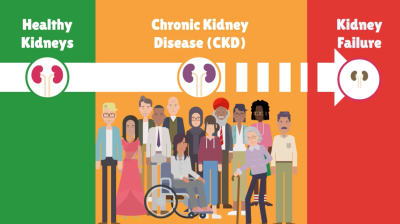 What is my risk of kidney failure with CKD (chronic kidney disease) | UHL NHS Trust Thumbnail