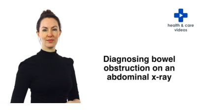 AXR Bowel Obstruction and Volvulus Thumbnail