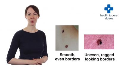 How to be skin aware The ABCDE of moles Thumbnail
