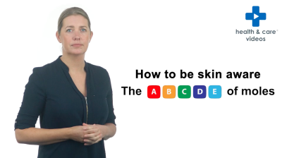 How to be skin aware The ABCDE of moles Thumbnail