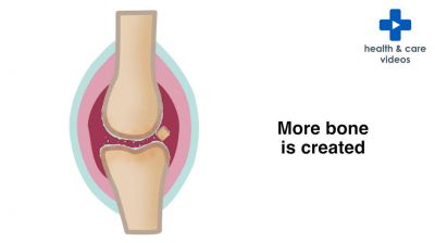 What is Osteoarthritis? Thumbnail