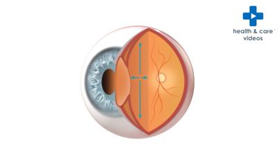 What is glaucoma and ocular hypertension? Thumbnail