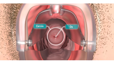 Cervical Smear 3D Animation Thumbnail